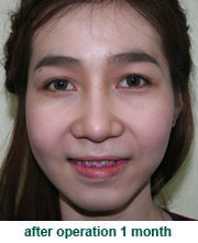 plastic_surgery_augmentation_rhinoplasty